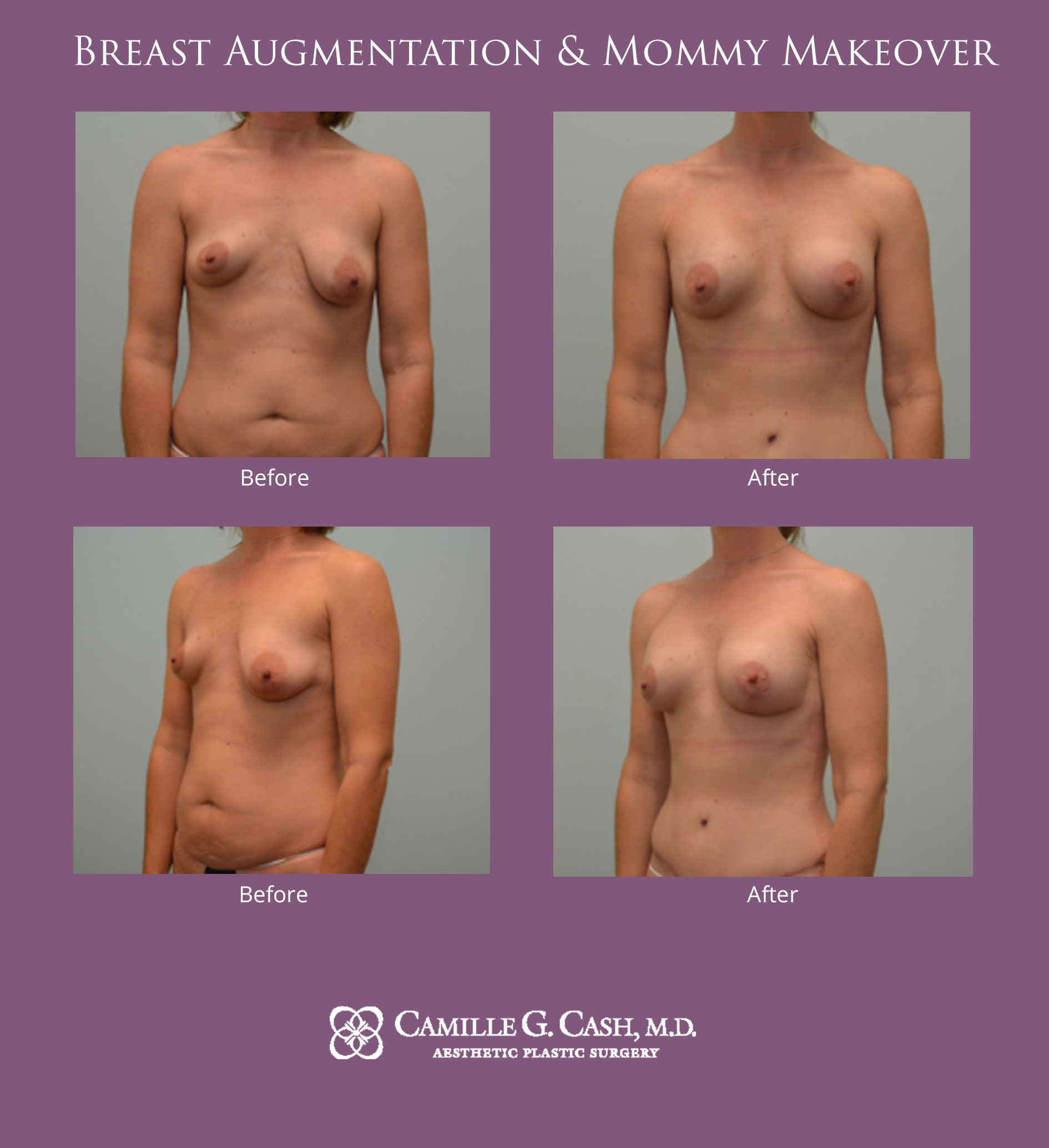 Breast augmentation & mommy makeover before and after photos
