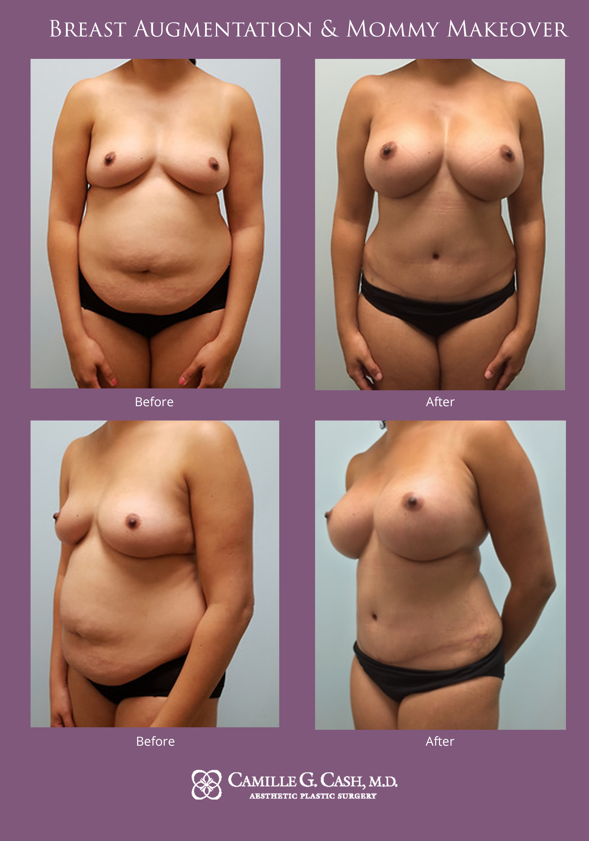 Breast augmentation and mommy makeover before and after photos