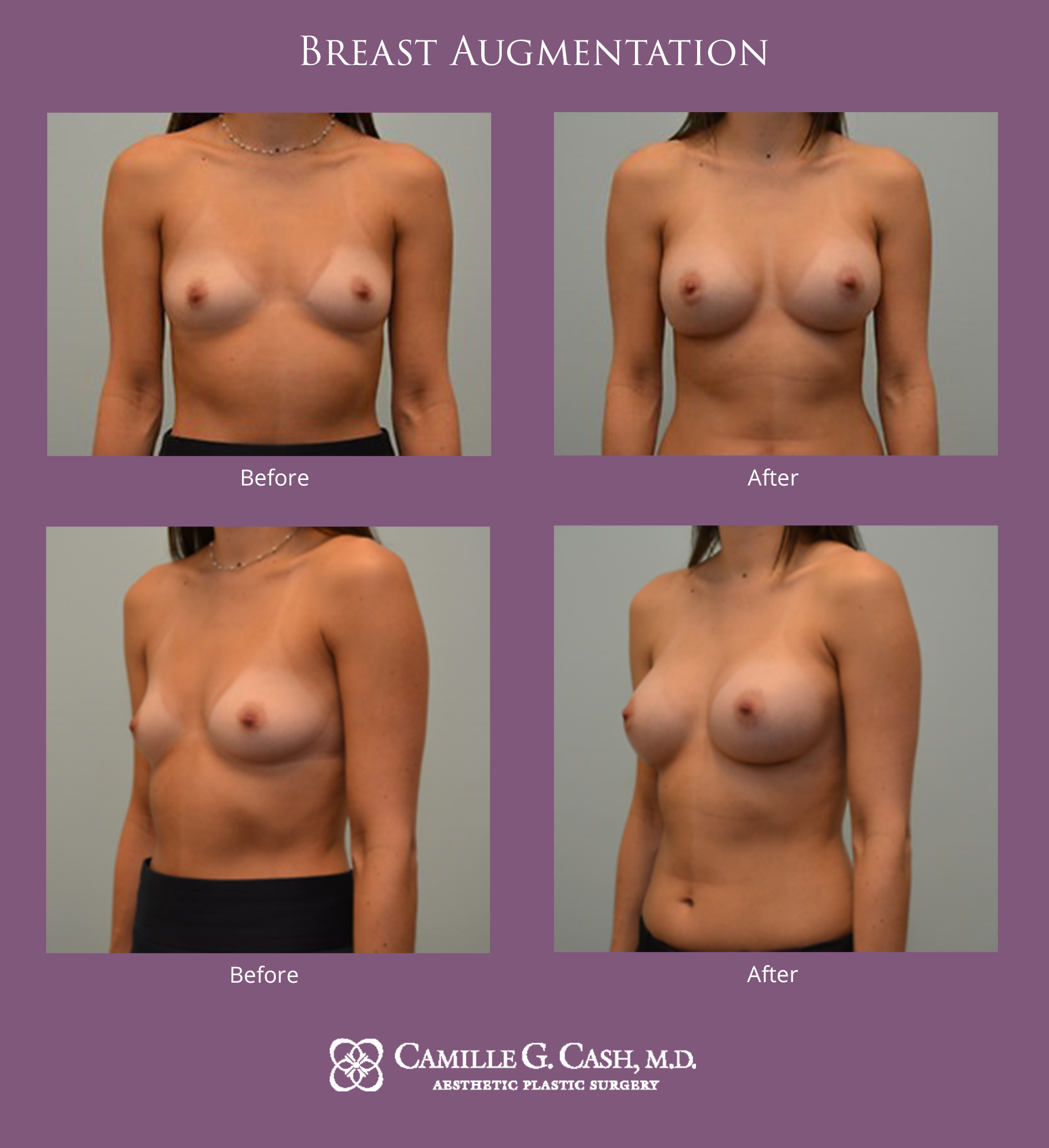 Breast augmentation before and after photos
