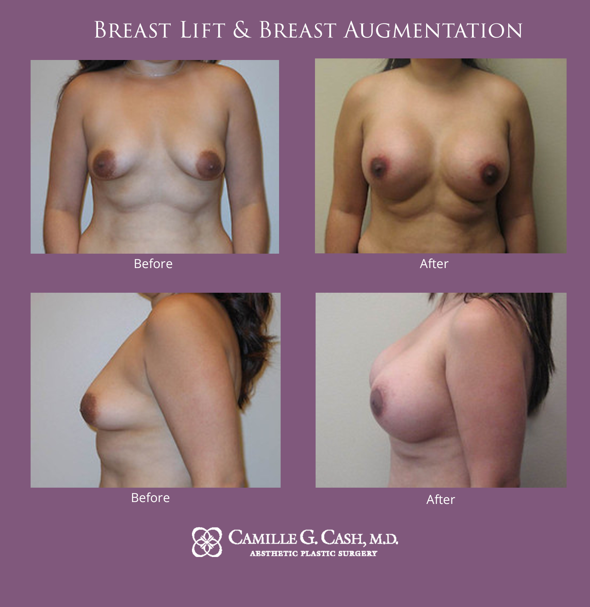 Breast lift with implants before and after photos