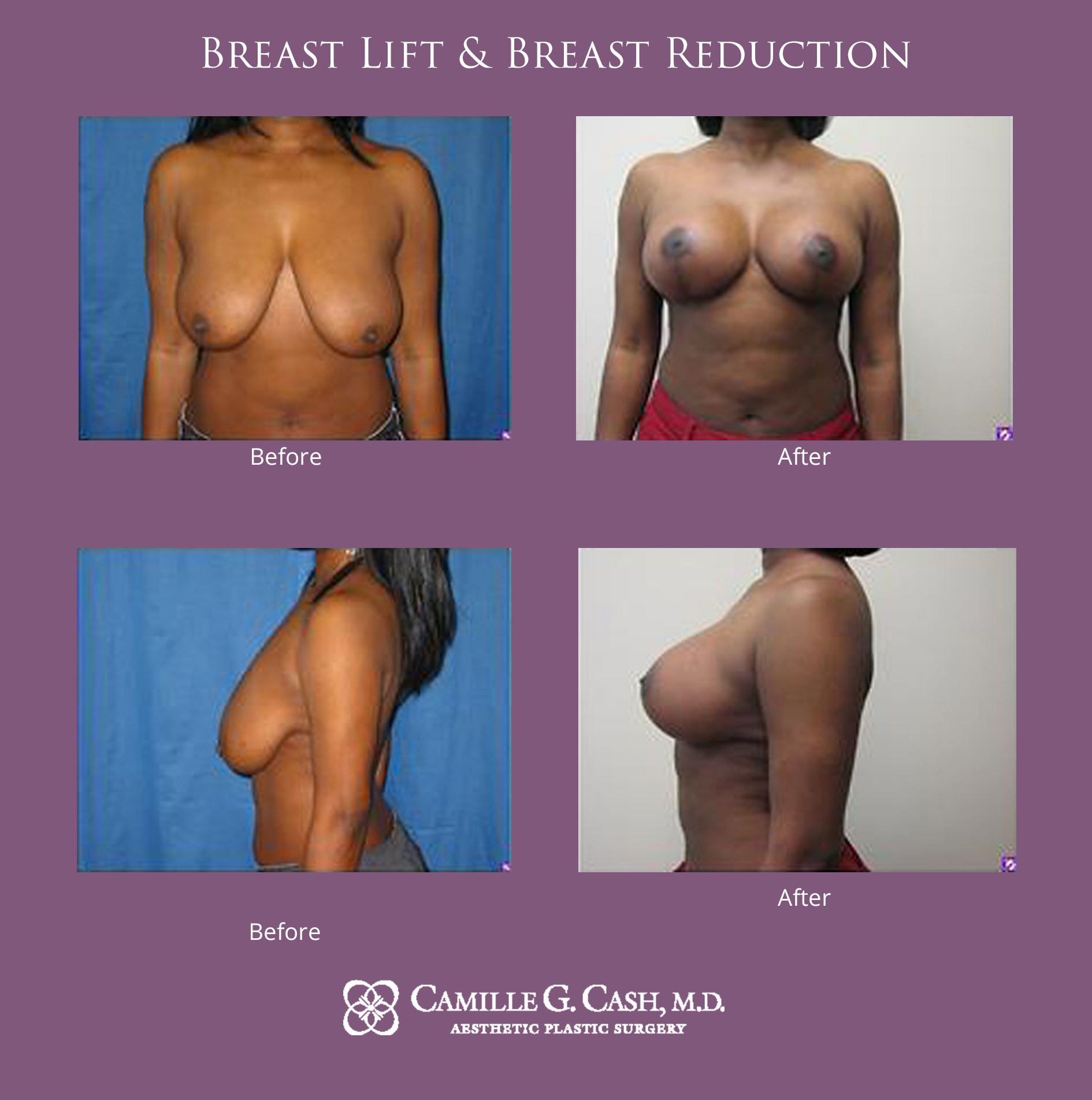 Breast lift and breast reduction before and after photos