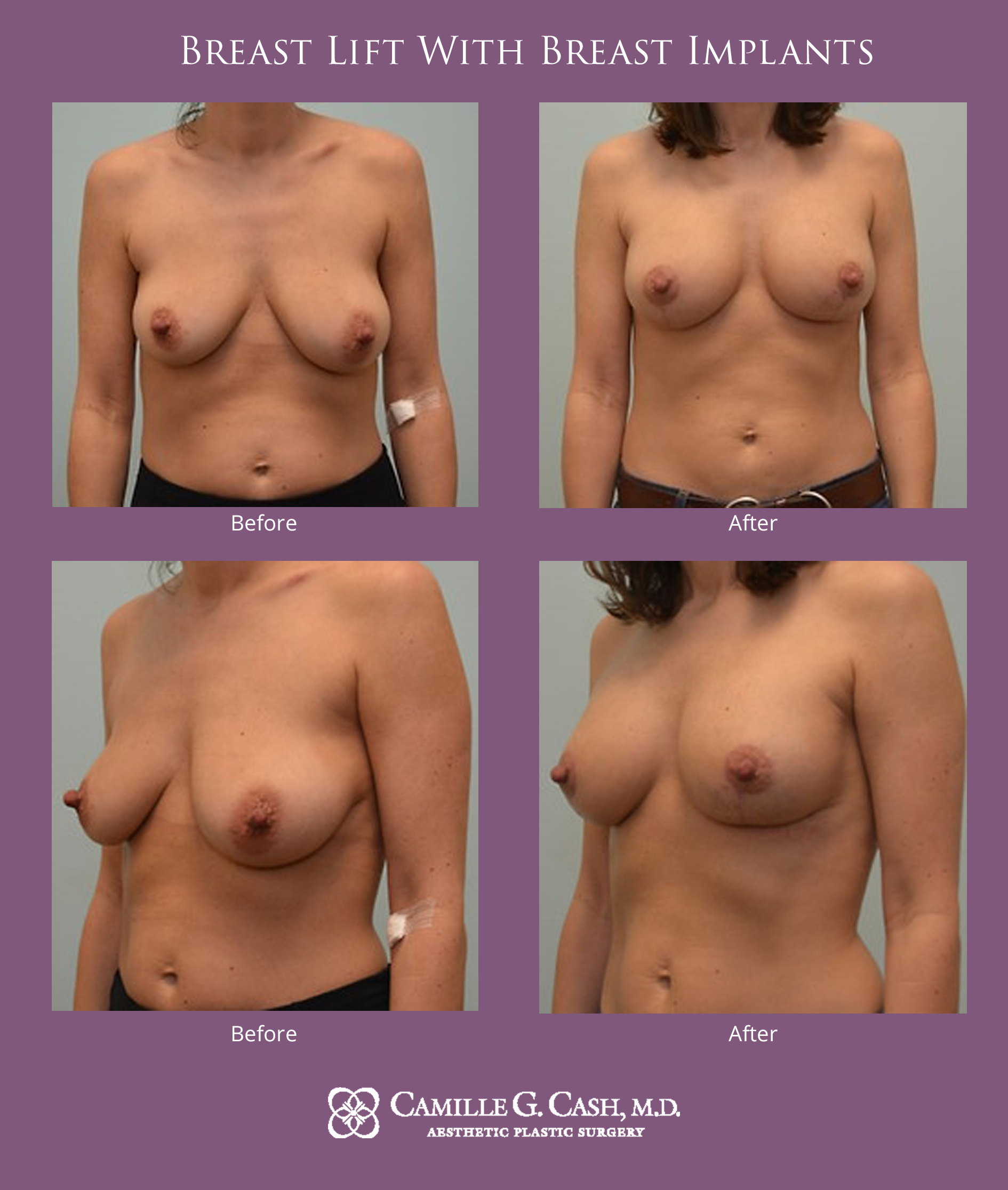 Breast lift with implants before and after photos