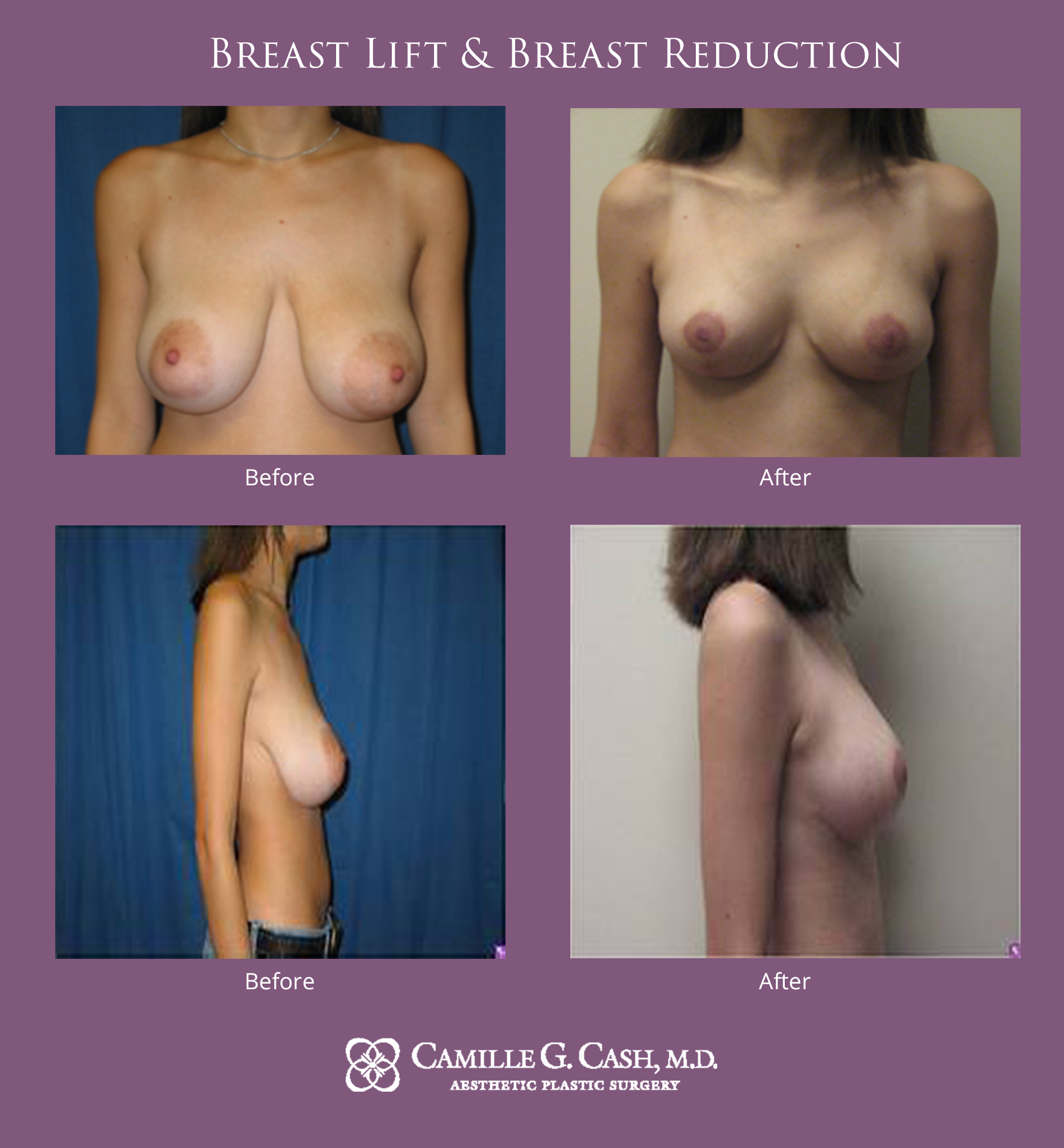 Breast lift and reduction before and after photos