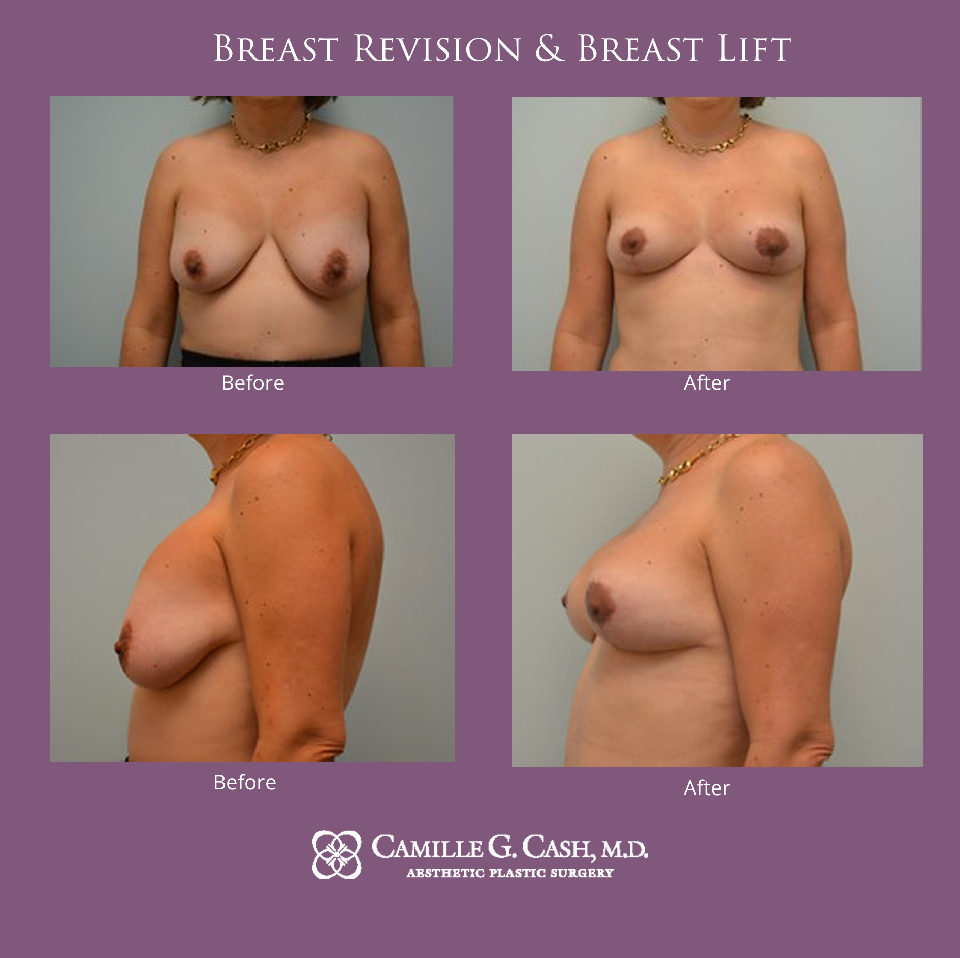 Breast revision and breast lift before and after photos