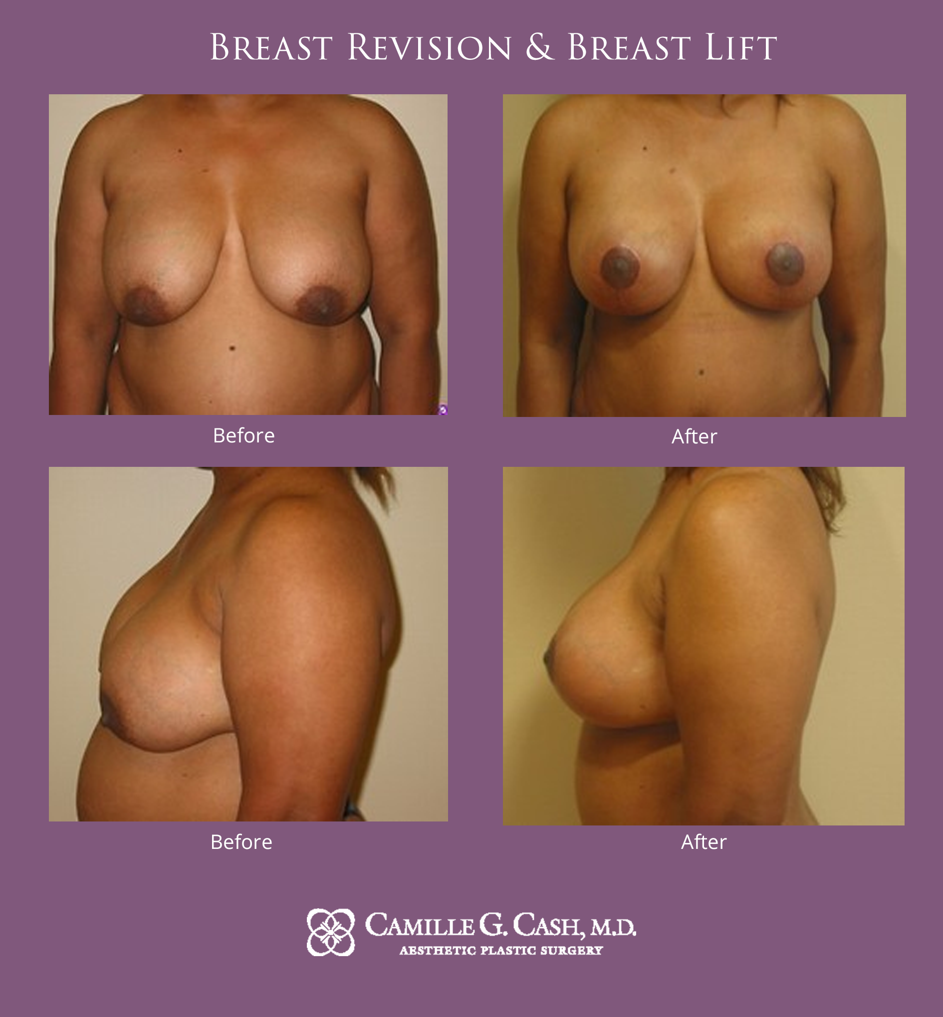 Breast revision and breast lift before and after photos