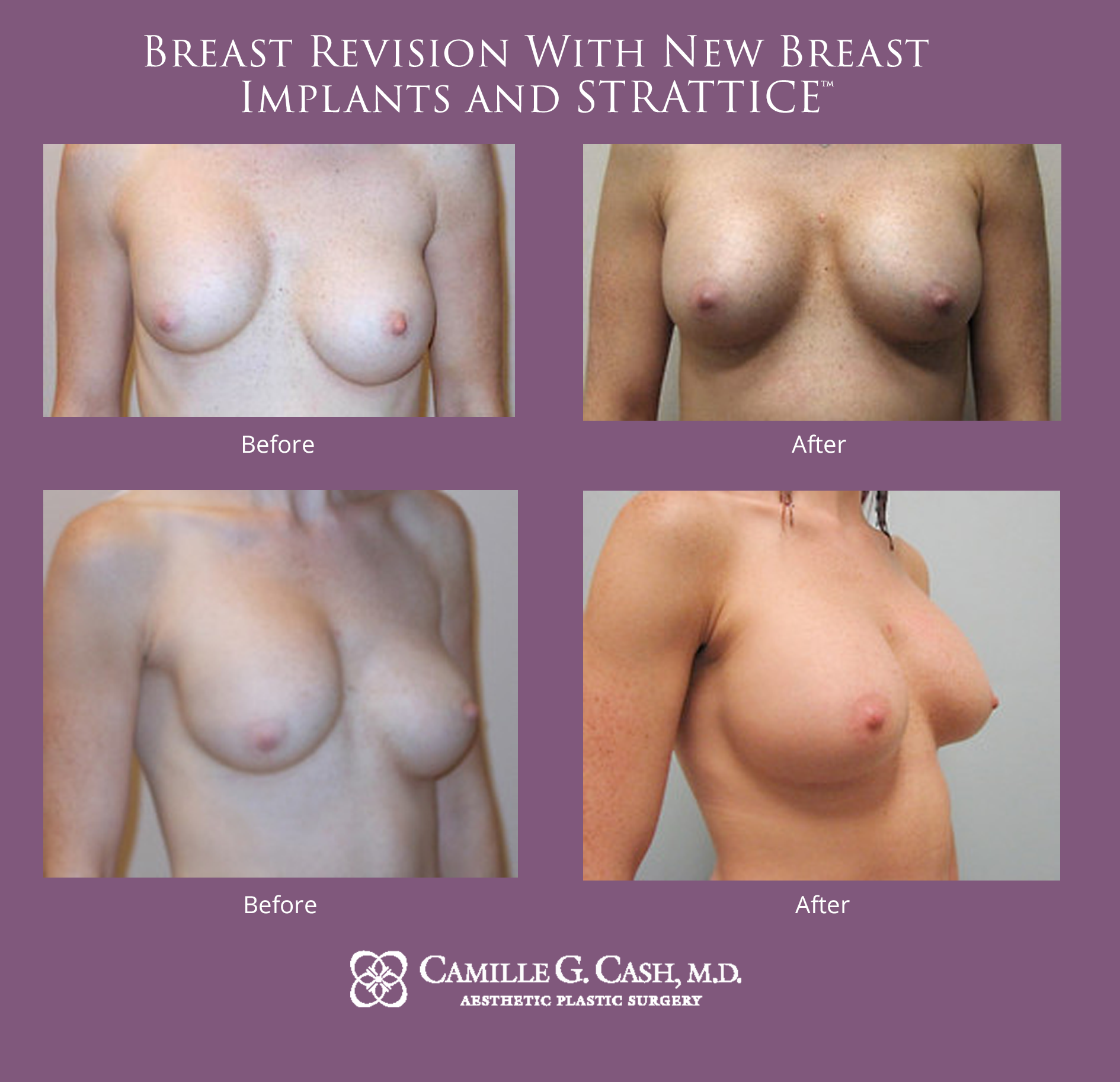 Breast revision with new breast implants and Strattice before and after photos