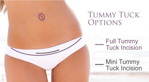 Tummy tuck options graphic