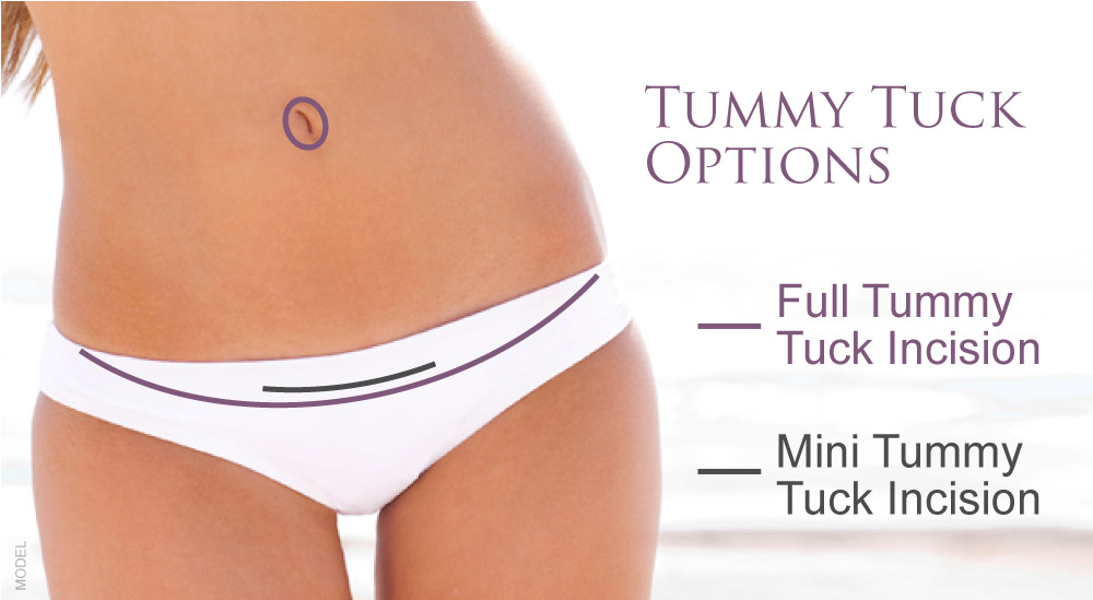 Mini and full abdominoplasty incisions