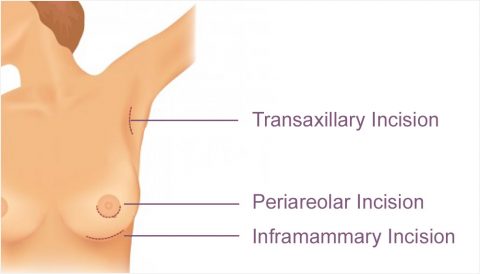 Breast incision diagram