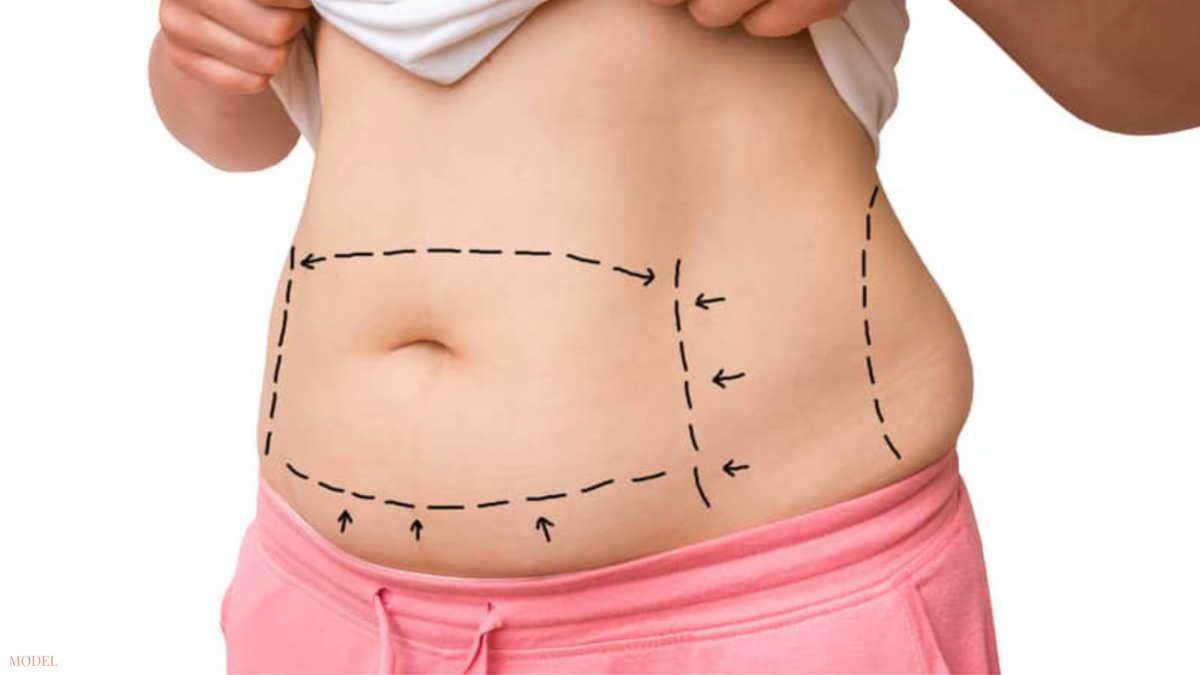 What Is an Inverted T Tummy Tuck?