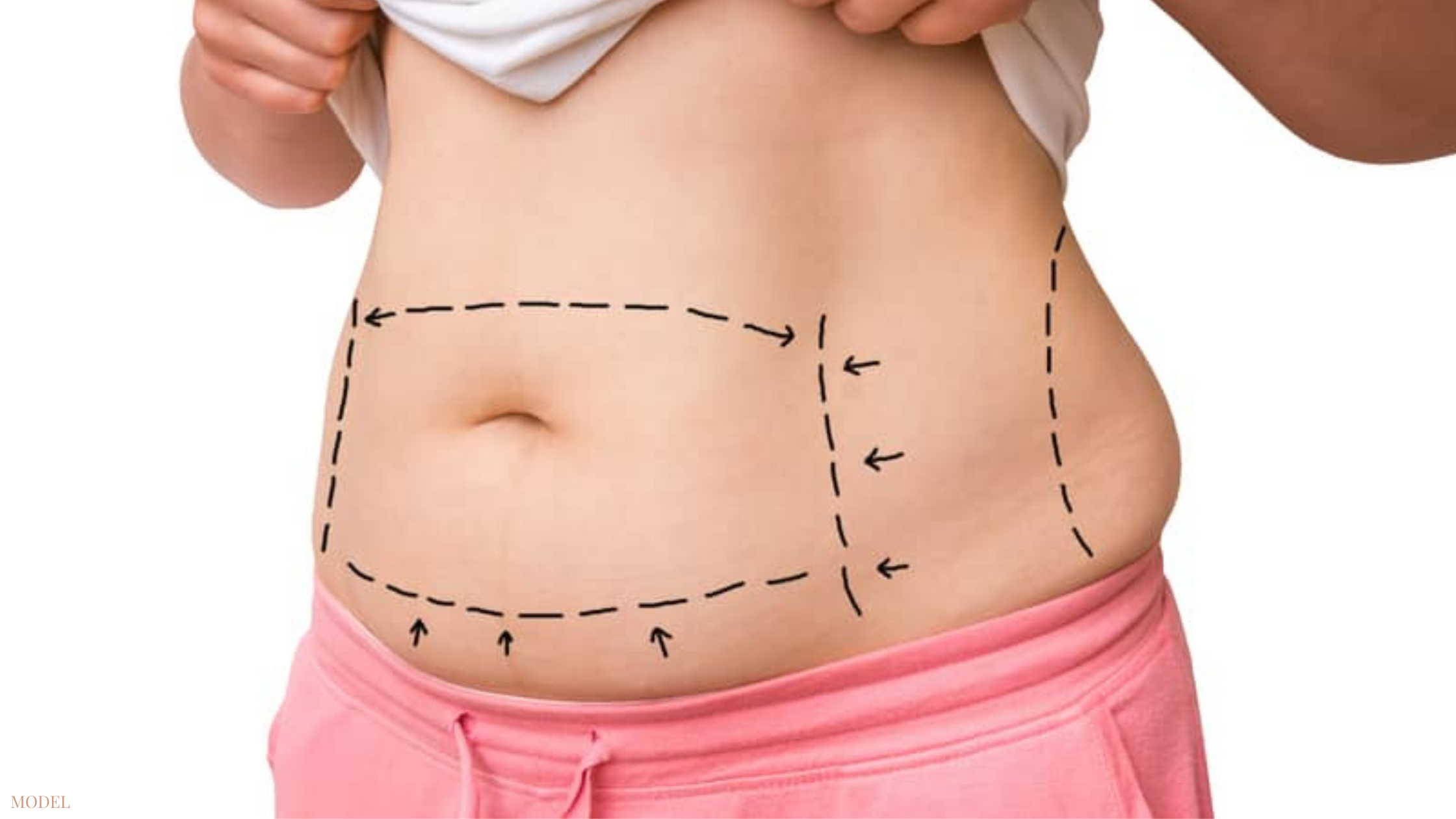 Tummy Tuck Boston – Abdominoplasty Boston, MA – Mini Tummy Tuck