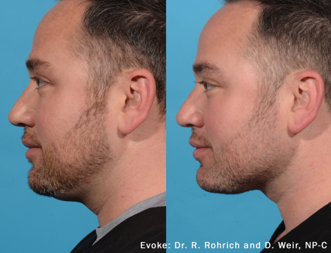 Evoke Neck - side view of neck before and after - male patient