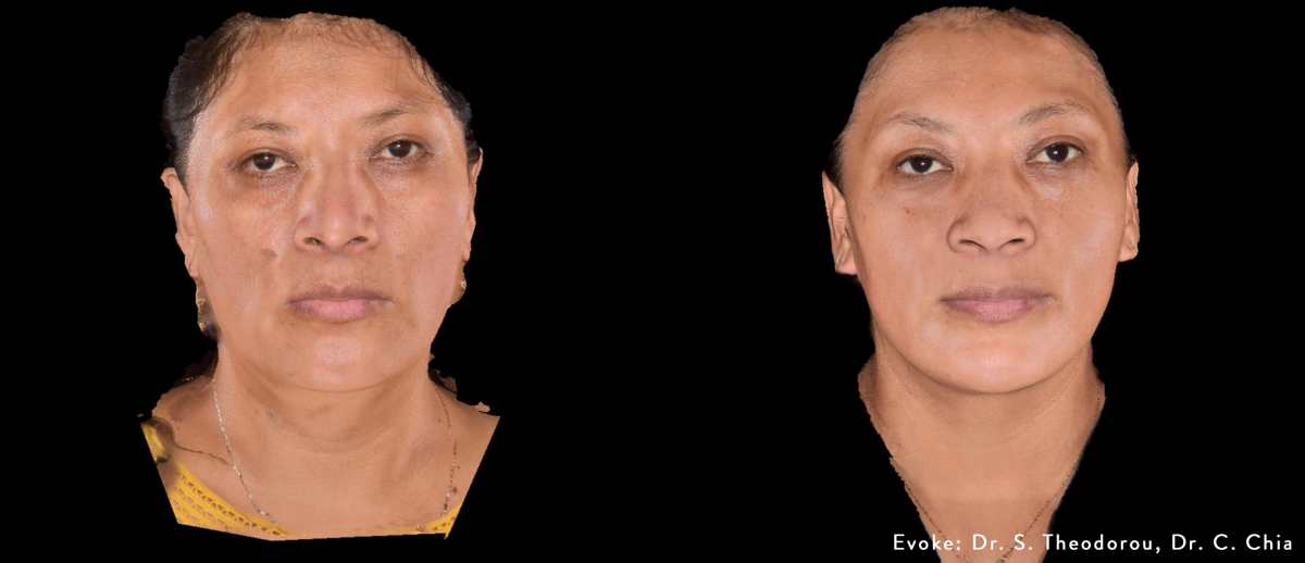 Evoke Face before and after results - front view, credit Dr. S. Theodorou and Dr. C. Chia