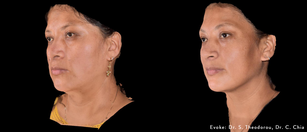 Evoke Face before and after results - oblique view, credit Dr. S. Theodorou and Dr. C. Chia