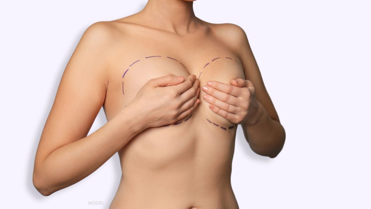 Woman holding breasts with markings with hands. (MODEL)