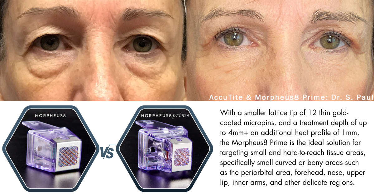 Before and after Morpheus8 prime and accutite for eye rejuvenation